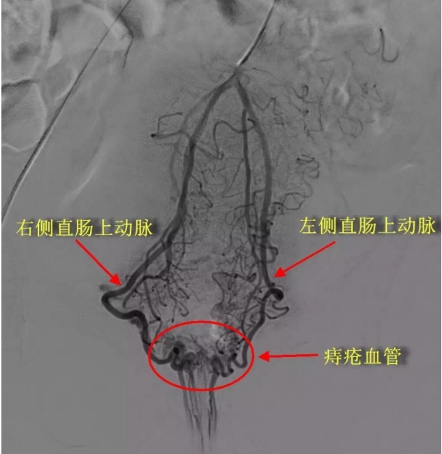 术前造影
