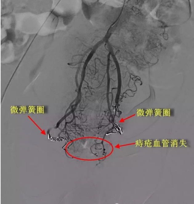 术后造影